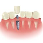 Technical graphic illustration of a dental implant.