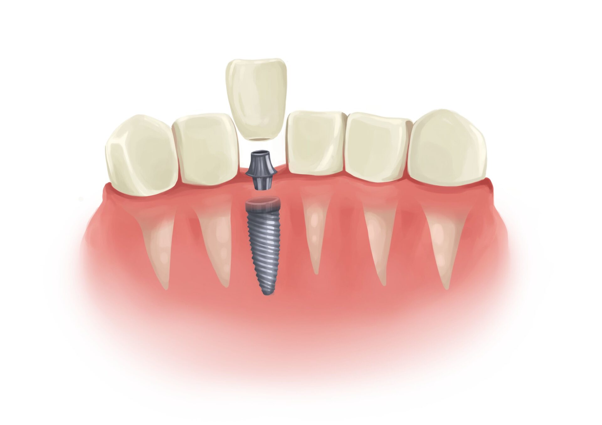 Technical graphic illustration of a dental implant.