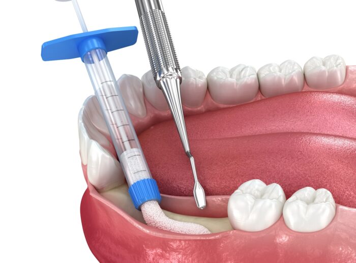 Bone grafting, augmentation. Medically accurate 3D illustration.