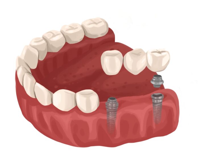 implant-supported dental bridge, traditional dental bridge, dental bridge
