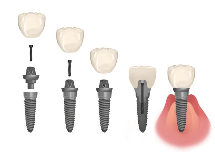 loose dental implant, dental emergency, Freitas Family Dentistry, Brentwood CA, implant care, peri-implantitis, dental health, Dr. Robert J. Freitas II Family Dentistry