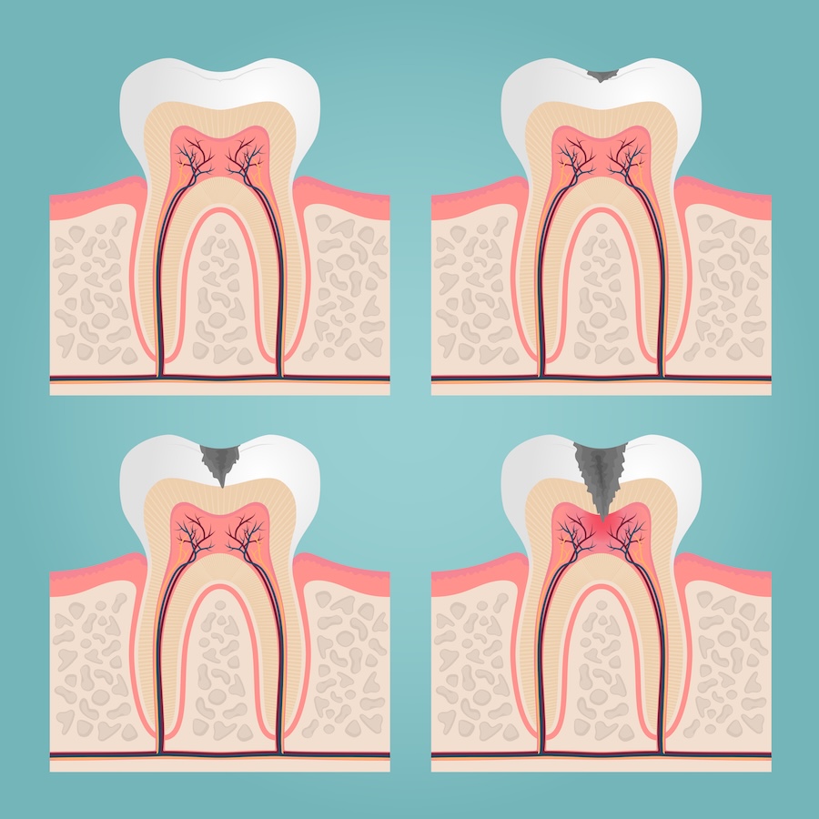 stages of cavity development